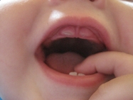 Ha jön a baba foga - tünetek és teendők