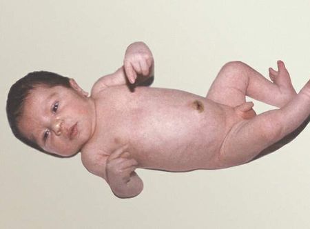 Kiütések, foltok, koszmó - az újszülöttek és csecsemők bőrelváltozásai