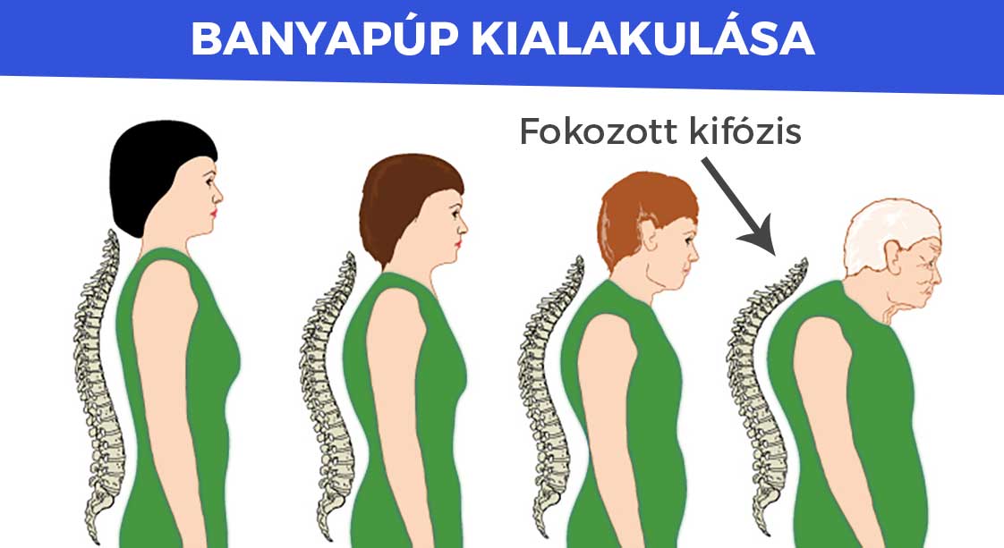 Banyapúp kialakulása, kezelése: Mit tehetsz a banyapúp ellen? - Szakember tanácsai