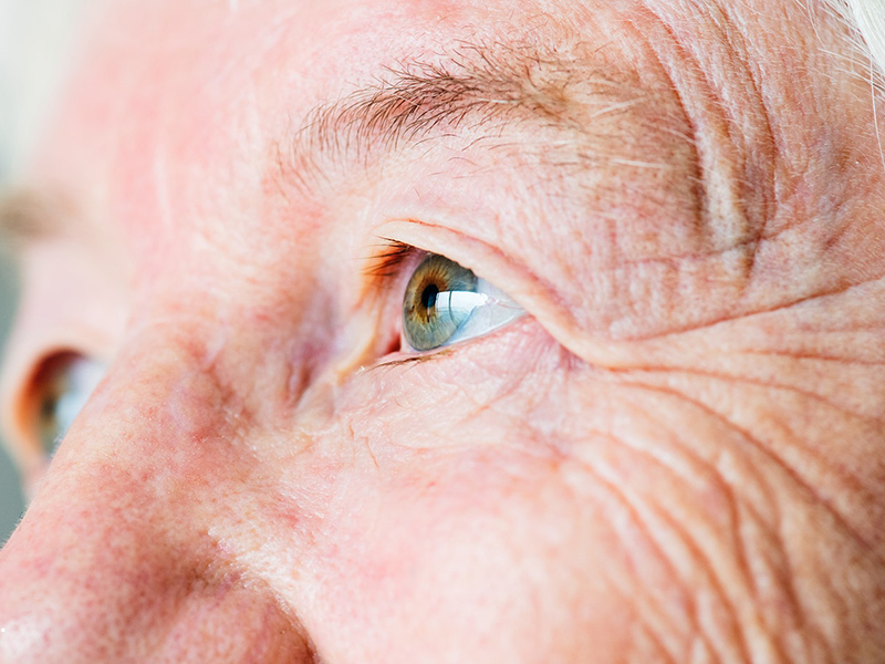 Fokozódó látásromlás, torz látás, szemfájdalom - Erre a súlyos rákbetegségre is utalhatnak a tünetek! - Mit kell tudni a szem melanómájáról?