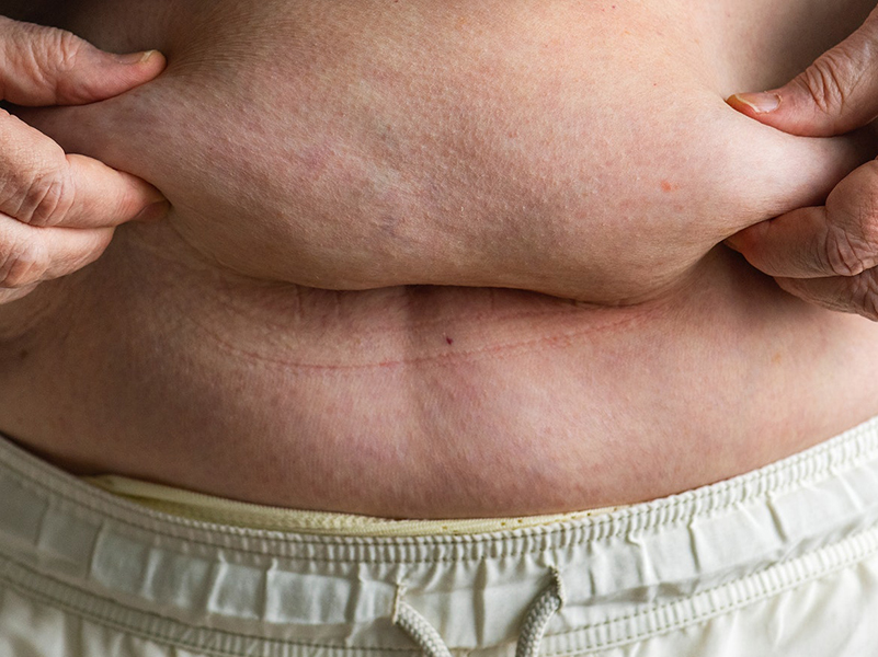 Körte vagy alma típusú elhízás - Miért jobb, ha inkább a combodra hízol, és nem a hasadra? 
