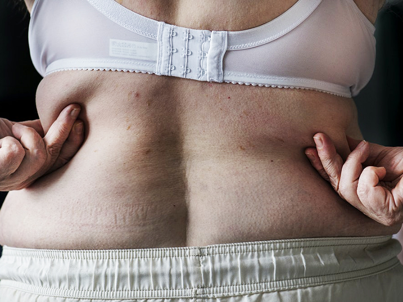 Vastagbélrák és elhízás: Fogyással jelentősen csökkenthető a vastagbélrák kialakulásának esélye